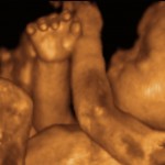 Will UN Categorically Exclude Unborn from Right to Life?