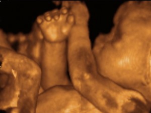 3d-ultrasound