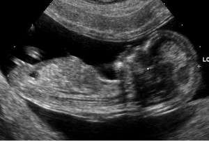 Embryo_at_12_weeks ultrasound abortion