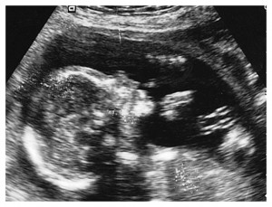 preborn baby ultrasound