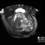 Amazing New Technology Shows Unborn Twins Jockeying for Space